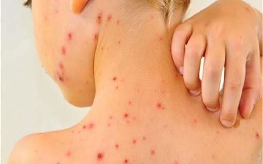 سرّ اليوم: الجدري يجتاح الشمال!